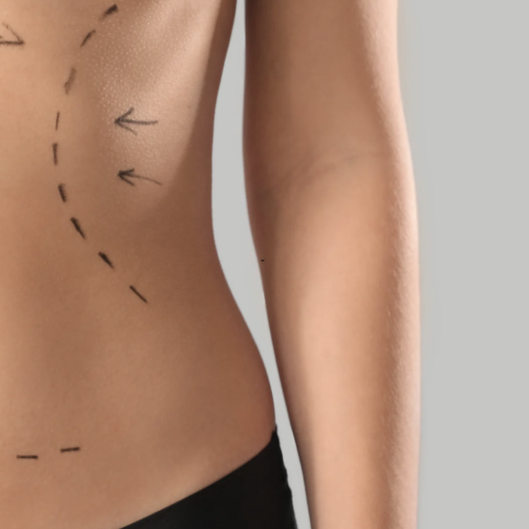 Tummy Tuck Costs in Arlington Virginia